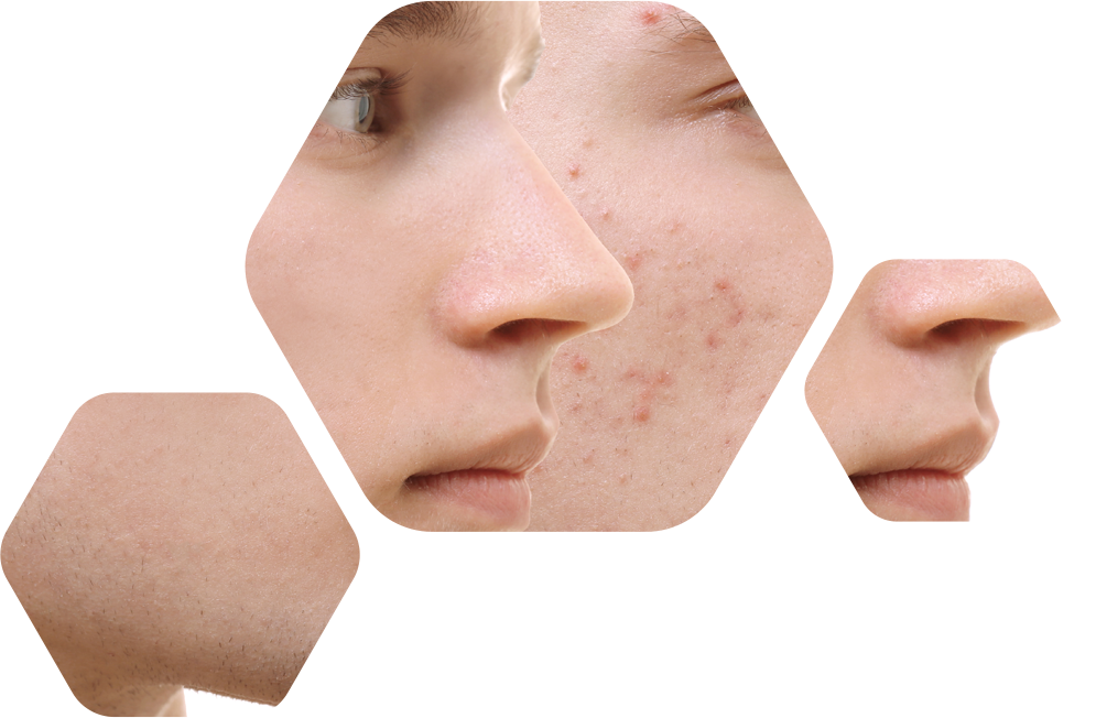 acneHexagonos