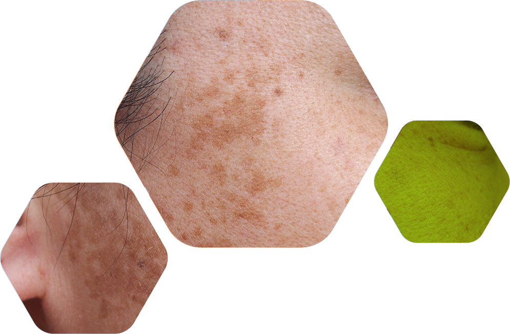 melasmaHexagonos