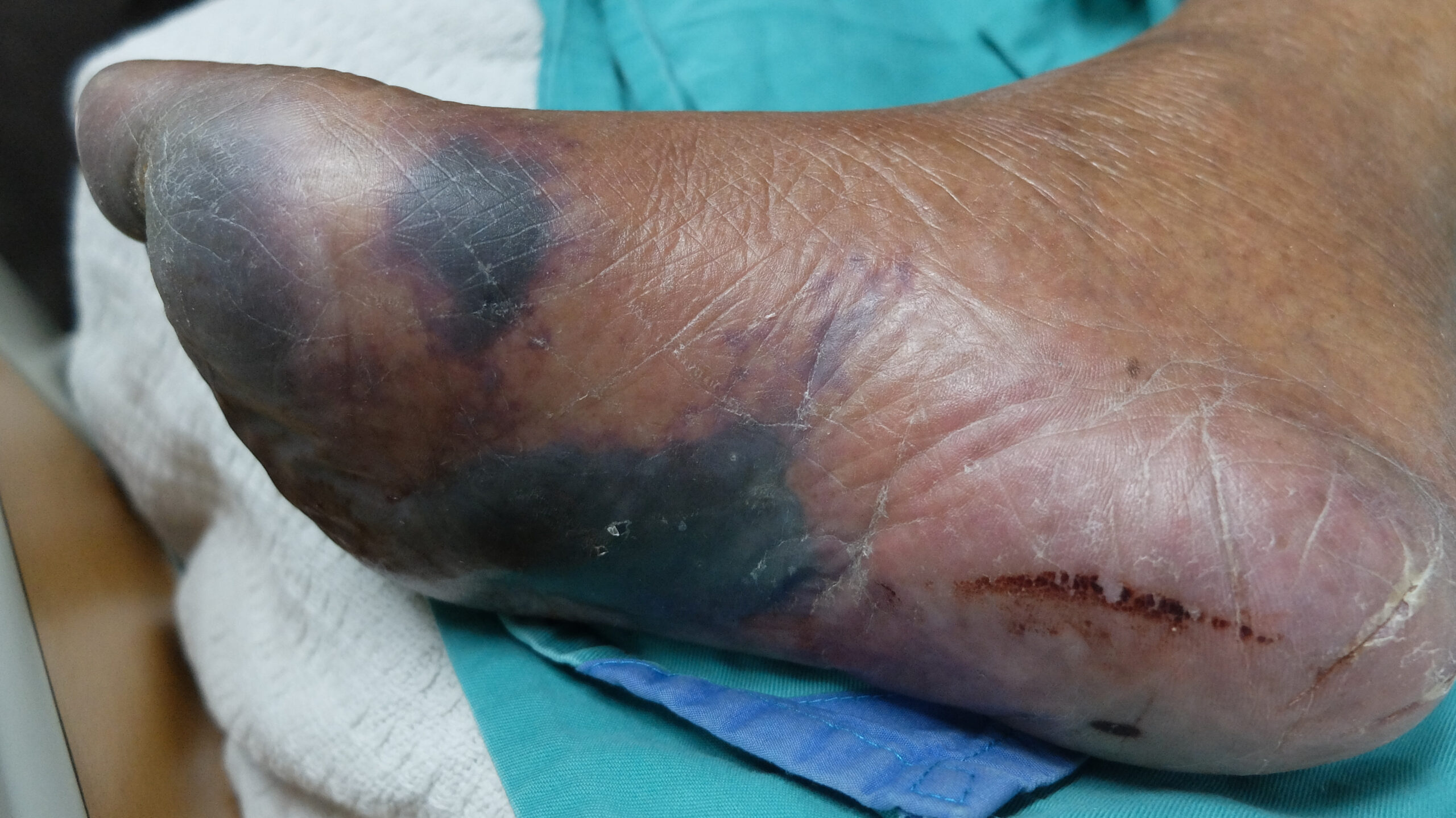 Gangrena localizada en pie, con el tiempo puede causar heridas que desencadenen pie diabético en el paciente. 