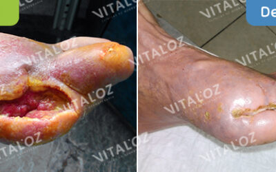 Clasificación del pie diabético | VitalOz