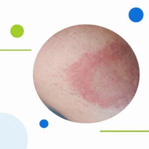 Detalle de una erupción cutánea circular característica de la enfermedad de Lyme.