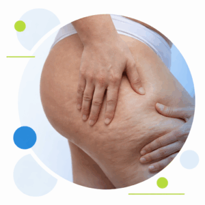 Ozonoterapia para la celulitis, un ratamiento estético eficaz.