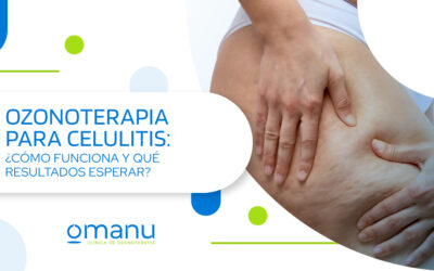 Ozonoterapia para la celulitis: ¿Cómo funciona y qué resultados esperar?