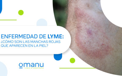 Enfermedad de Lyme: ¿Cómo son las manchas rojas que aparecen en la piel?
