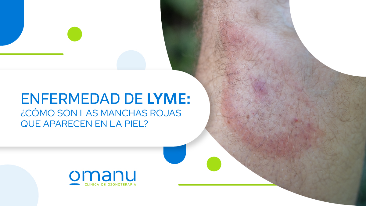 Lesión cutánea con manchas rojas circulares en la piel característica de la enfermedad de Lyme causada por picadura de garrapata